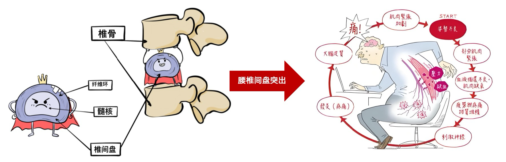 Discseel®Procedure・DST椎间盘修复再生术：重塑纤维环，阻断腰椎病变四阶段升级路