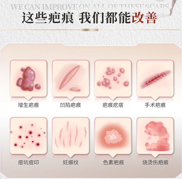 新疆威兹曼，为病理性疤痕治疗领航